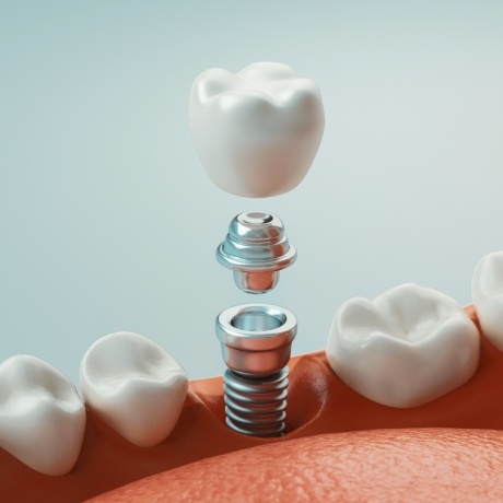 Illustration of dental implant in Corinth replacing a missing lower tooth