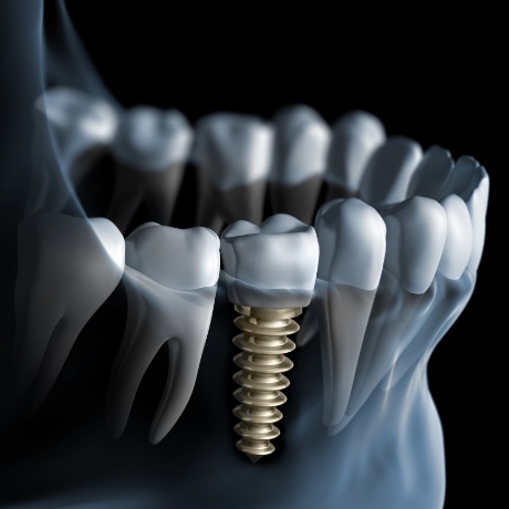 Illustrated x ray of person with dental implant replacing a missing tooth