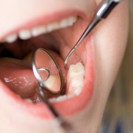 Close up of dental patient having their teeth examined