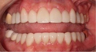 Mouth after treating darkened and damaged teeth