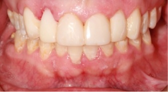 Mouth after fixing damaged upper teeth