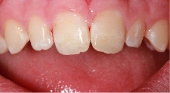 Mouth after correcting stains on two upper front teeth