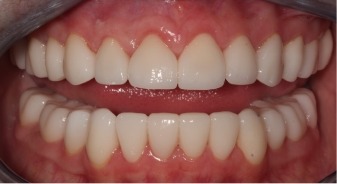 Mouth after fixing stubby and yellowed teeth