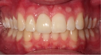 Close up of mouth after placing crown on worn down tooth