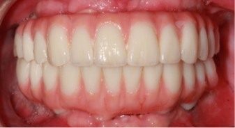 Mouth with whiter and more evenly spaced teeth
