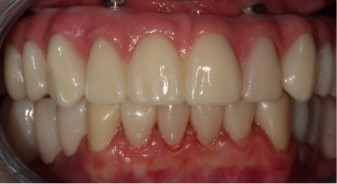 Mouth with newly restored whiter teeth with no gaps