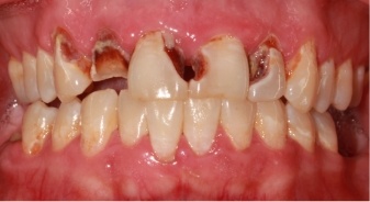Mouth with multiple severely damaged upper teeth