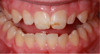 Mouth with stains on two upper front teeth