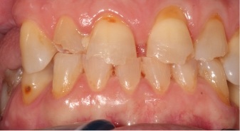 Mouth with yellowed gapped damaged teeth