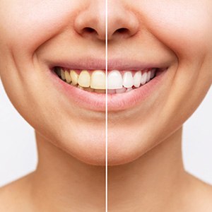 A cropped before-and-after shot of a woman who received teeth whitening