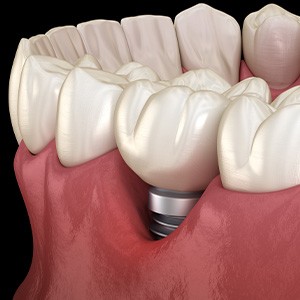 Illustration of a single dental implant