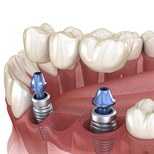 Illustration of an implant bridge