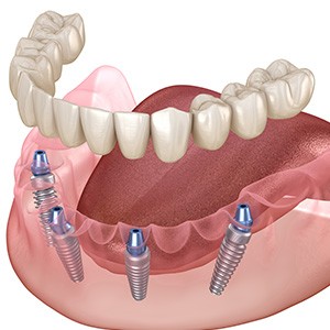 Illustration of an implant denture